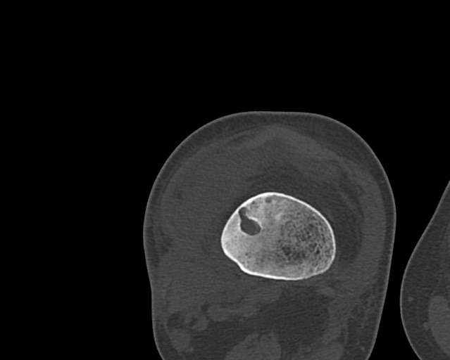 Chronic ostemyelitis of the femur with long sinus tract (Radiopaedia 74947-85982 Axial bone window 194).jpg