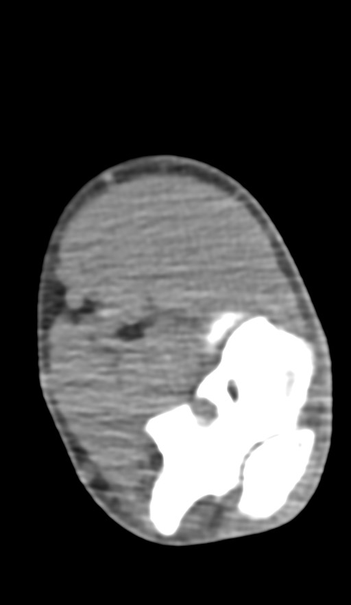 Chronic osteomyelitis of the distal humerus (Radiopaedia 78351-90971 Axial non-contrast 95).jpg