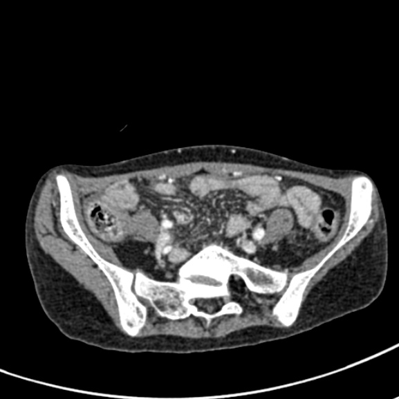 Chronic pancreatitis (Radiopaedia 55405-61846 A 77).jpg
