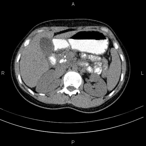 Chronic pancreatitis (Radiopaedia 64576-73450 Axial non-contrast 50).jpg