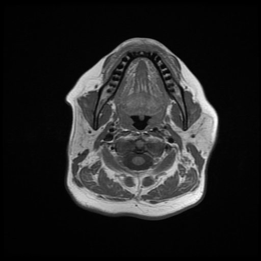 File:Chronic submandibular sialadenitis (Radiopaedia 61852-69885 Axial T1 11).jpg