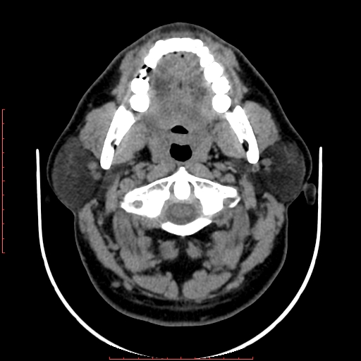 Chronic submandibular sialolithiasis (Radiopaedia 69817-79814 Axial non-contrast 64).jpg