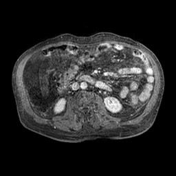 Cirrhosis and hepatocellular carcinoma in the setting of hemochromatosis (Radiopaedia 75394-86594 Axial T1 C+ fat sat 267).jpg