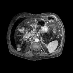 File:Cirrhosis and hepatocellular carcinoma in the setting of hemochromatosis (Radiopaedia 75394-86594 Axial T1 C+ fat sat 304).jpg