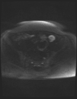 File:Class II Mullerian duct anomaly- unicornuate uterus with rudimentary horn and non-communicating cavity (Radiopaedia 39441-41755 Axial DWI 72).jpg