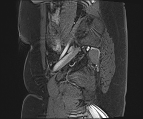 File:Class II Mullerian duct anomaly- unicornuate uterus with rudimentary horn and non-communicating cavity (Radiopaedia 39441-41755 G 11).jpg