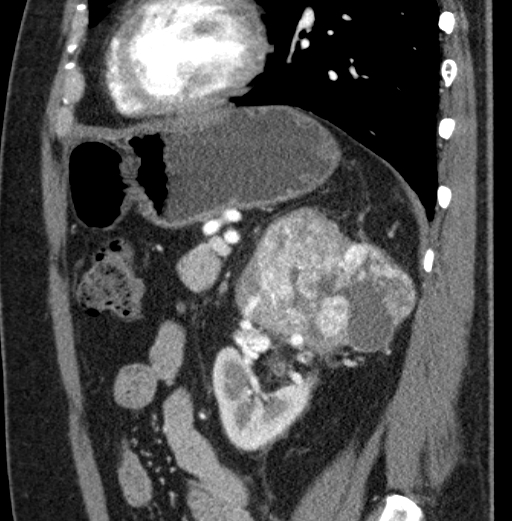 File:Clear cell renal cell carcinoma (Radiopaedia 61449-69393 D 29).jpg