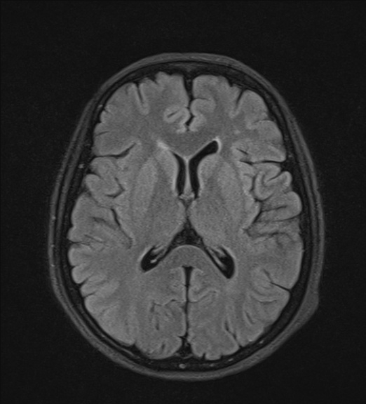 File:Clival meningioma (Radiopaedia 53278-59248 Axial FLAIR 14).jpg
