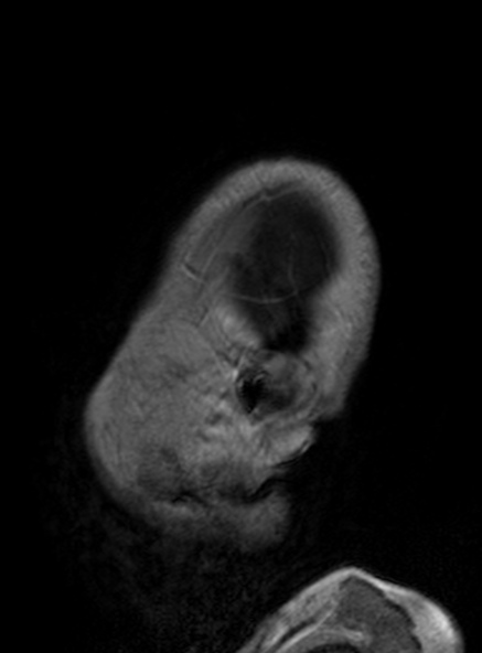 Clival meningioma (Radiopaedia 53278-59248 Sagittal T1 C+ 128).jpg