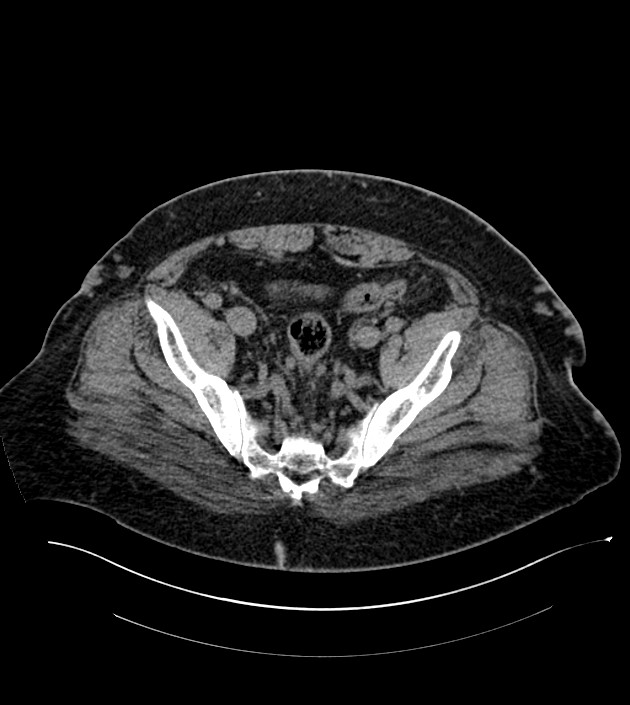 Closed-loop small bowel obstruction-internal hernia (Radiopaedia 78439-91096 Axial non-contrast 129).jpg