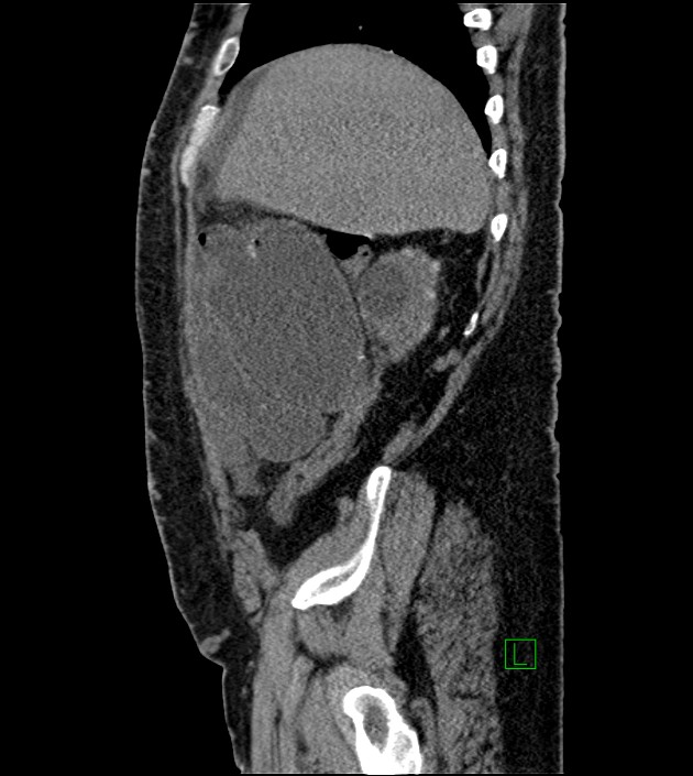 Closed-loop small bowel obstruction-internal hernia (Radiopaedia 78439-91096 C 113).jpg