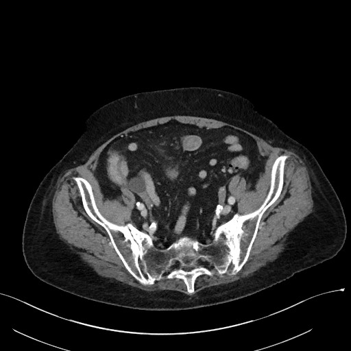 Closed loop small bowel obstruction - adhesions (Radiopaedia 59269-66611 A 101).jpg