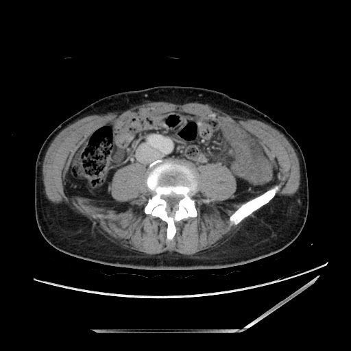 Closed loop small bowel obstruction - omental adhesion causing "internal hernia" (Radiopaedia 85129-100682 A 102).jpg