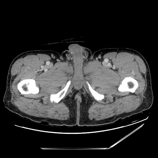 File:Closed loop small bowel obstruction - omental adhesion causing "internal hernia" (Radiopaedia 85129-100682 A 189).jpg