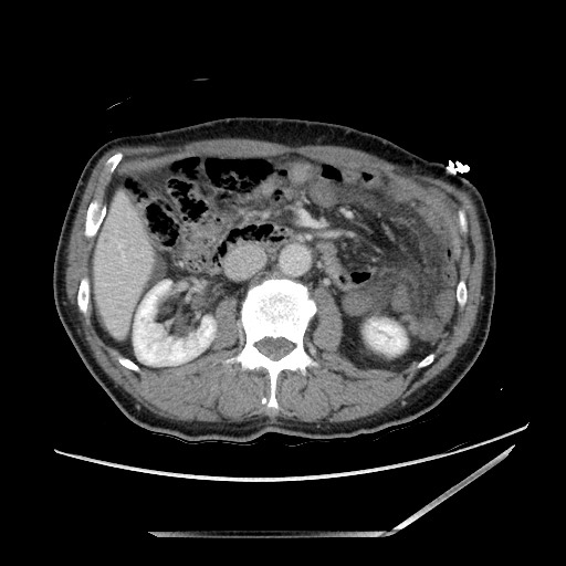 Closed loop small bowel obstruction - omental adhesion causing "internal hernia" (Radiopaedia 85129-100682 A 69).jpg