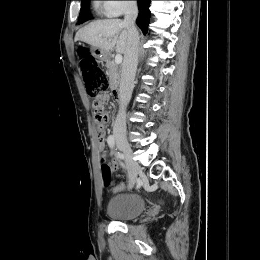 Closed loop small bowel obstruction - omental adhesion causing "internal hernia" (Radiopaedia 85129-100682 C 82).jpg