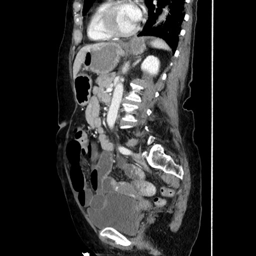 Closed loop small bowel obstruction due to adhesive band, with intramural hemorrhage and ischemia (Radiopaedia 83831-99017 D 118).jpg