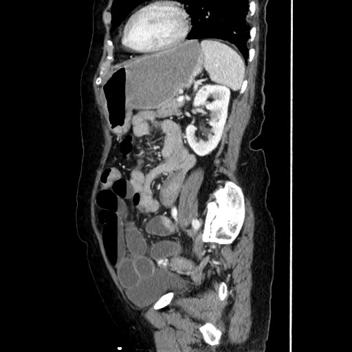 Closed loop small bowel obstruction due to adhesive band, with intramural hemorrhage and ischemia (Radiopaedia 83831-99017 D 131).jpg