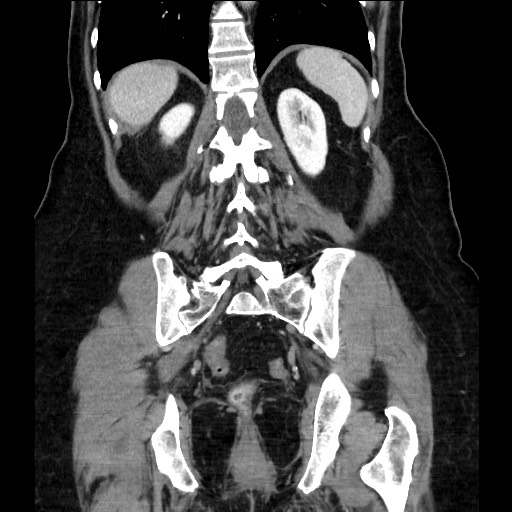 Closed loop small bowel obstruction due to adhesive bands - early and late images (Radiopaedia 83830-99014 B 93).jpg