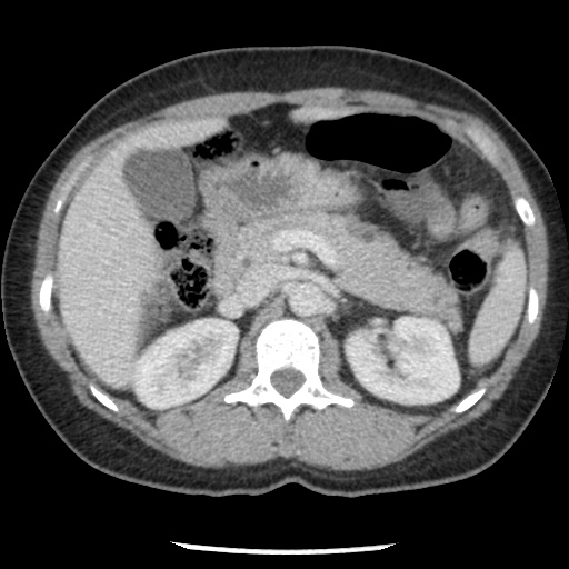 Closed loop small bowel obstruction due to trans-omental herniation (Radiopaedia 35593-37109 A 32).jpg