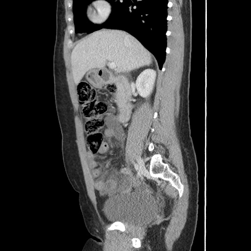 Closed loop small bowel obstruction due to trans-omental herniation (Radiopaedia 35593-37109 C 26).jpg