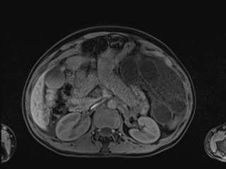Closed loop small bowel obstruction in pregnancy (MRI) (Radiopaedia 87637-104031 Axial T1 fat sat 46).jpg