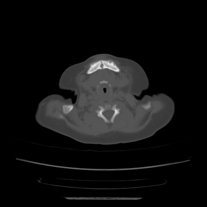 Cloverleaf skull (Radiopaedia 91901-109710 Axial bone window 19).jpg