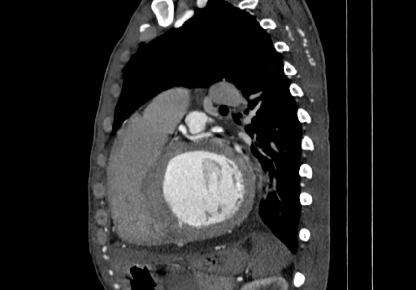 Coarctation of aorta with aortic valve stenosis (Radiopaedia 70463-80574 B 113).jpg