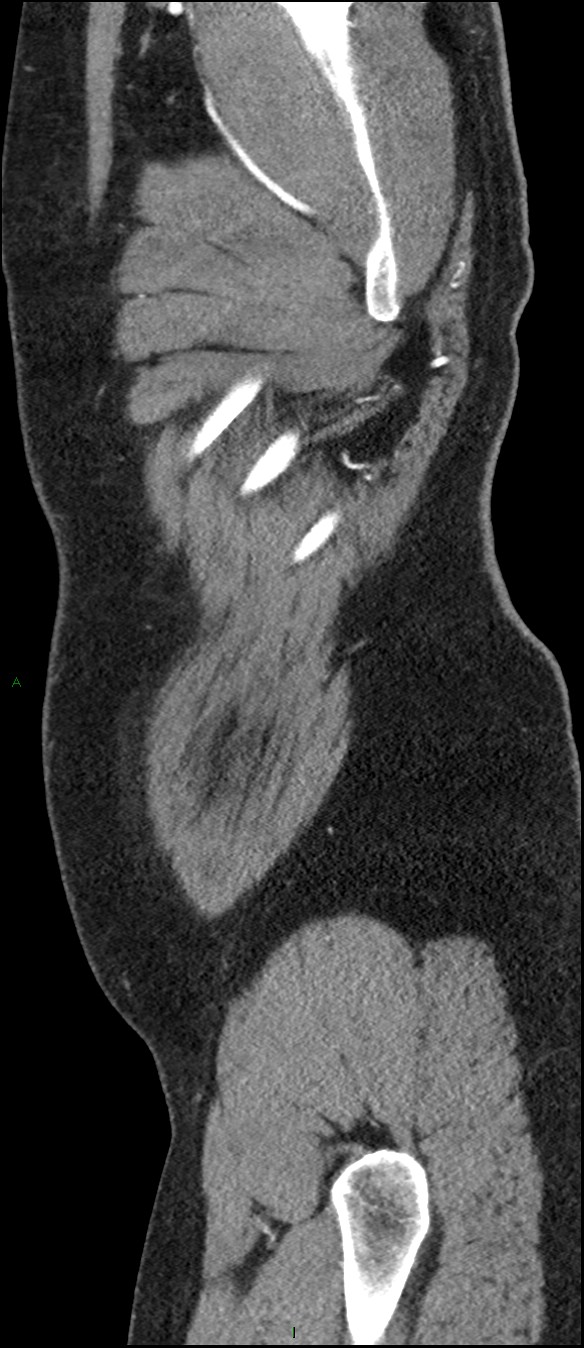 Coarctation of the aorta (Radiopaedia 74632-88521 C 315).jpg