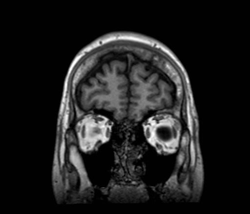 Cochlear incomplete partition type III associated with hypothalamic hamartoma (Radiopaedia 88756-105498 Coronal T1 54).jpg