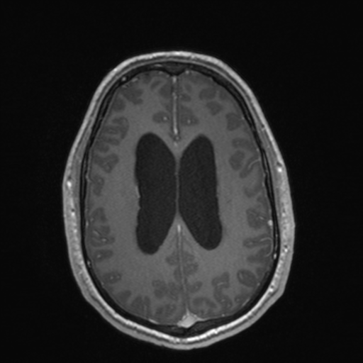 File:Colloid cyst (Radiopaedia 44510-48181 Axial T1 C+ 124).png