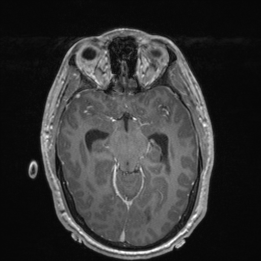 File:Colloid cyst (Radiopaedia 44510-48181 Axial T1 C+ 77).png