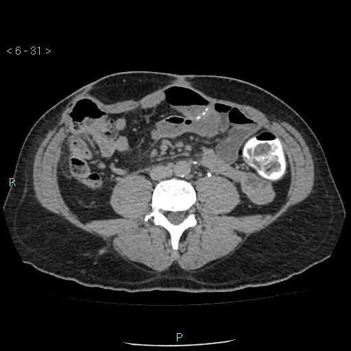 File:Colo-cutaneous fistula (Radiopaedia 40531-43129 A 12).jpg