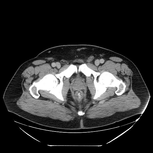 Colocolic intussusception due to lipoma (Radiopaedia 73712-84508 A 114).jpg