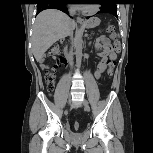 File:Colocutaneous fistula in Crohn's disease (Radiopaedia 29586-30093 Coronal non-contrast 19).jpg