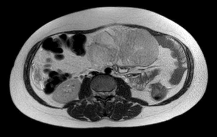File:Colon adenocarcinoma with Krukenberg tumors, advanced pregnancy (Radiopaedia 67279-76645 Axial T2 43).jpg
