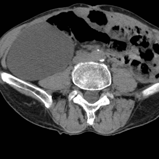 Colon cancer with calcified liver metastasis (Radiopaedia 74423-85309 Axial non-contrast 65).jpg