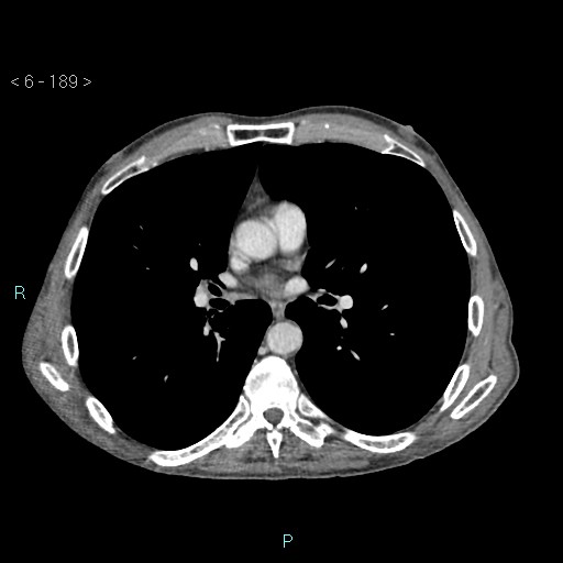 File:Colonic cancer (ultrasound and TC imaging) (Radiopaedia 50346-55713 B 189).jpg