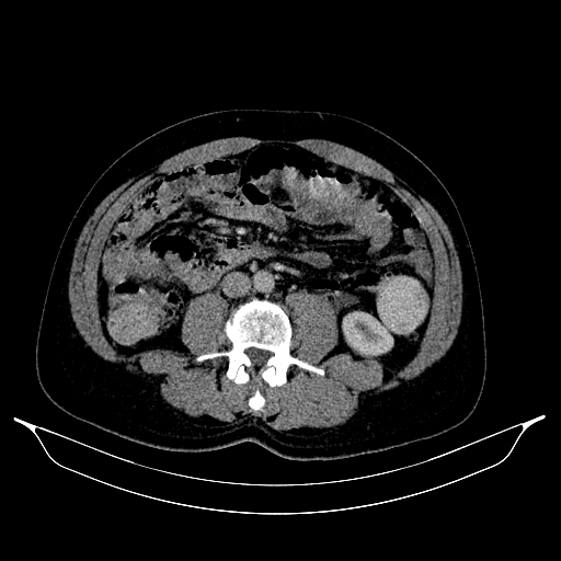 Colonic diverticulosis (Radiopaedia 72222-82744 A 28).jpg