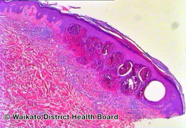 File:Figure 1 (DermNet NZ pathology-w-cherryangiomafigure1).jpg