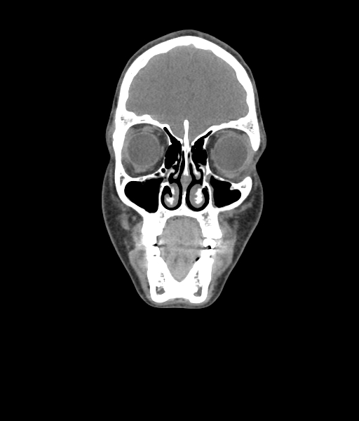Nasal pyogenic granuloma (lobular capillary hemangioma) (Radiopaedia 85536-101244 Coronal non-contrast 65).jpg