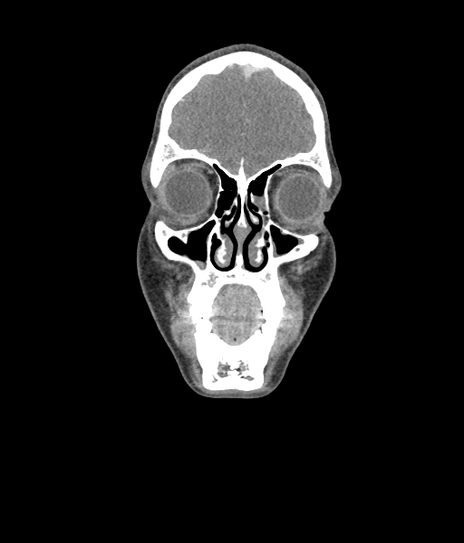 Nasal pyogenic granuloma (lobular capillary hemangioma) (Radiopaedia 85536-101244 D 50).jpg