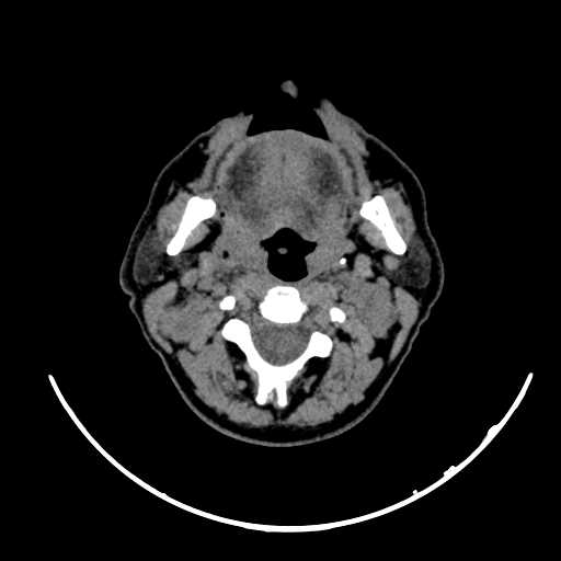File:Nasopharyngeal carcinoma - infiltrating the clivus (Radiopaedia 62583-70875 Axial non-contrast 30).jpg