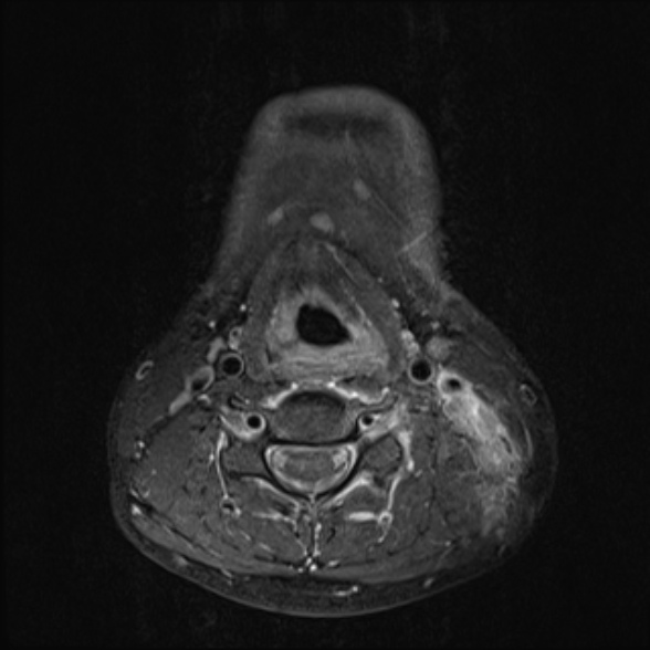 Nasopharyngeal carcinoma with skull base invasion (Radiopaedia 53415-59485 Axial T1 C+ fat sat 54).jpg