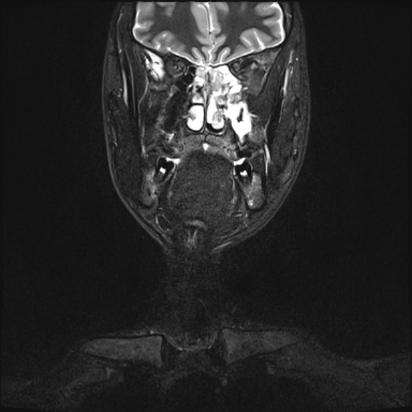 Nasopharyngeal carcinoma with skull base invasion (Radiopaedia 53415-59485 Coronal T2 fat sat 28).jpg