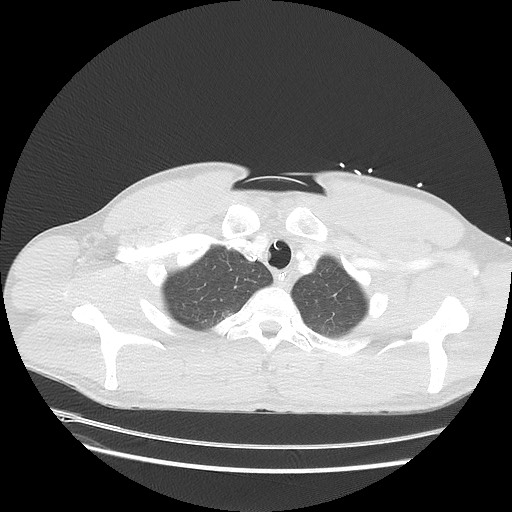 Near-drowning pulmonary edema (Radiopaedia 59457-66814 Axial lung window 6).jpg