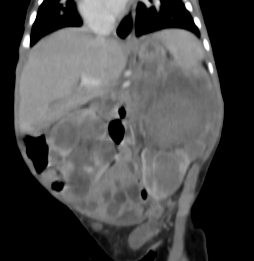 Nephroblastomatosis (Radiopaedia 71294-81607 B 185).jpg
