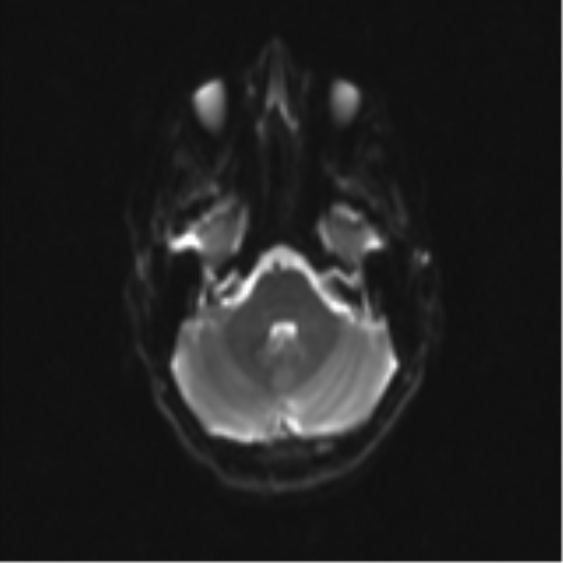 Neurenteric cyst (Radiopaedia 58641-65837 Axial DWI 10).png