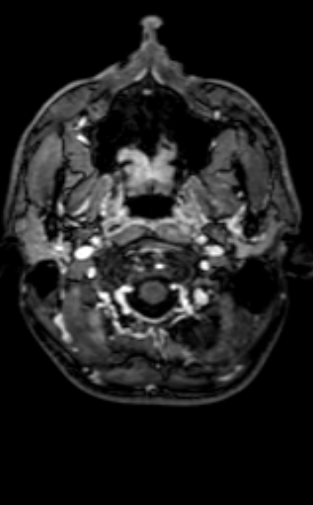 Neuro-Behçet disease (Radiopaedia 90112-107294 Axial T1 C+ 199).jpg