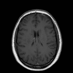 File:Neuro-Behcet's disease (Radiopaedia 21557-21505 Axial T1 C+ 14).jpg